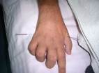 Lyle Merner Accupuncture on Hand